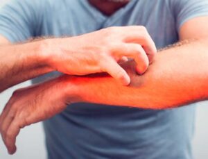 Kaşıntının sebepleri