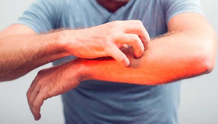 Kaşıntının sebepleri