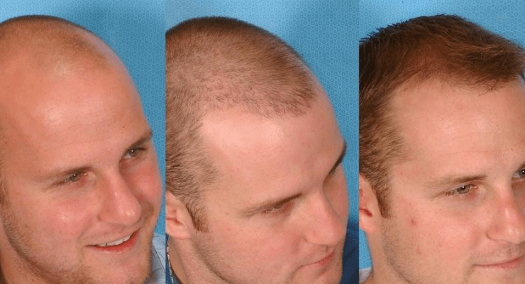 Türkiye, Saç Ekimi ve Bakımında Küresel Liderliğe Yöneliyor