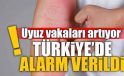 Uyuz Vakalarında Türkiye’de Alarm Zilleri Çalıyor! Belirtiler ve Korunma Yolları Neler?